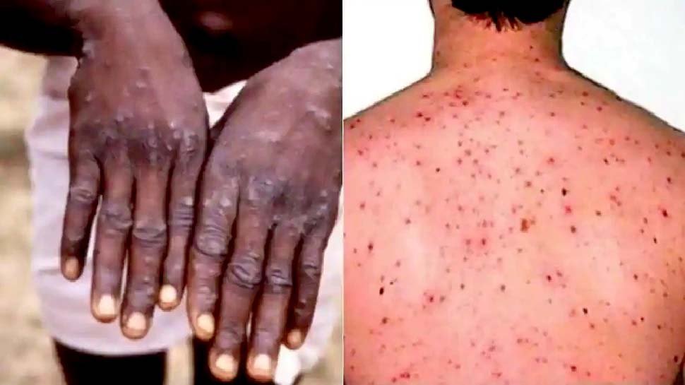 बेलायतमा मंकीपक्सः यौन सम्पर्कबाट जोगिन सरकारको निर्देशन 