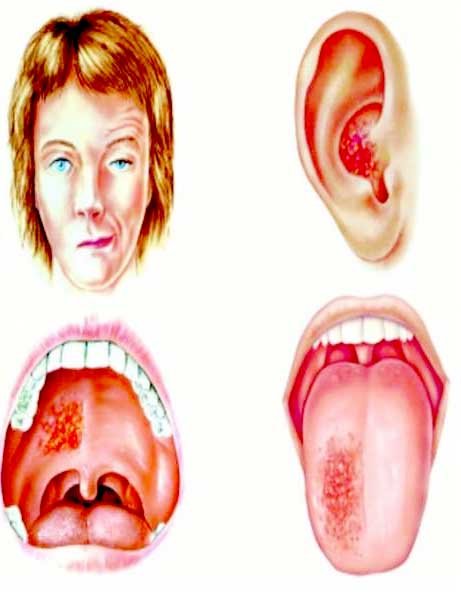 के हो रामसे हन्ट सिन्ड्रोम ? 